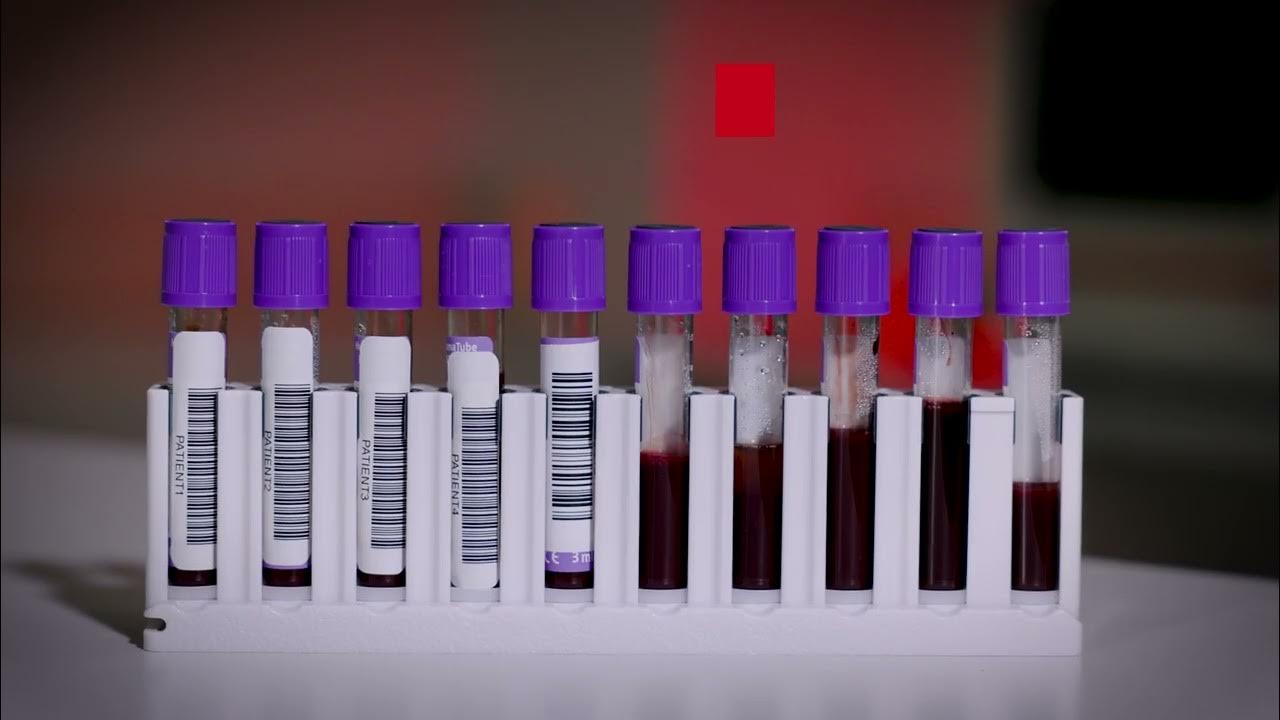 ¿Qué es el A1C? Guía en Español para Controlar la Diabetes